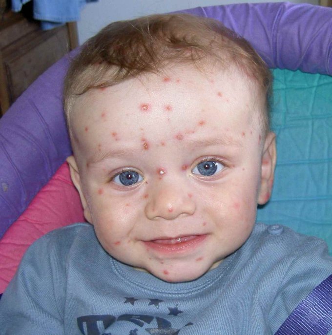 La varicelle chez le bébé
