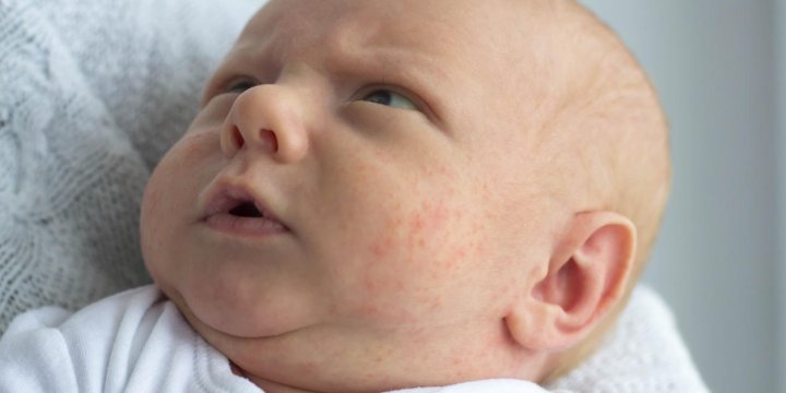 Petits boutons rouges sur le visage de bébé : 3 causes