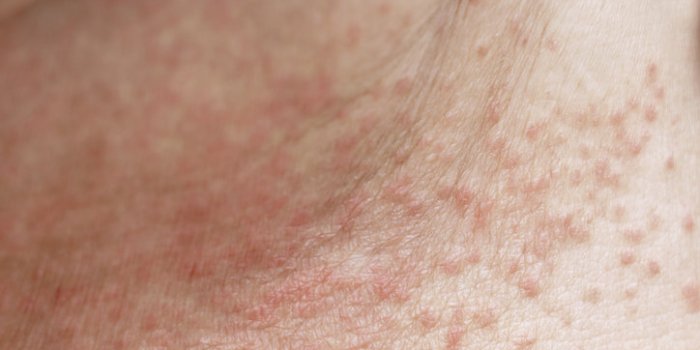 skin disease prickly heat rash or miliaria on belly skin of woman healthcare skin cause for outdoor work in sunny with ho...