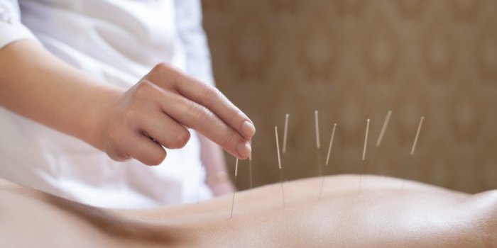 acupuncturist doctor makes a therapy for woman