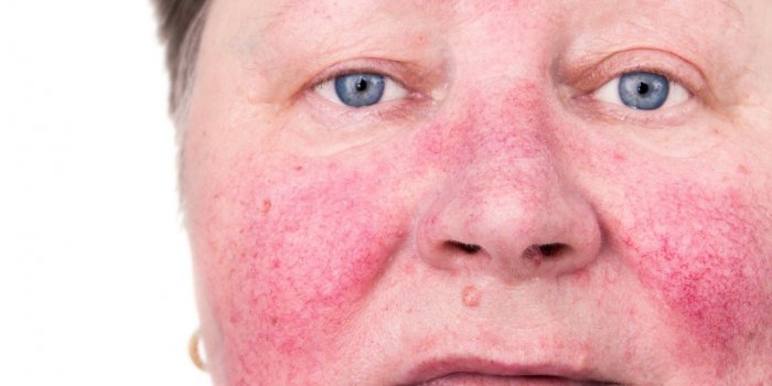 Hiver : 5 signes qui montrent que votre peau souffre du froid