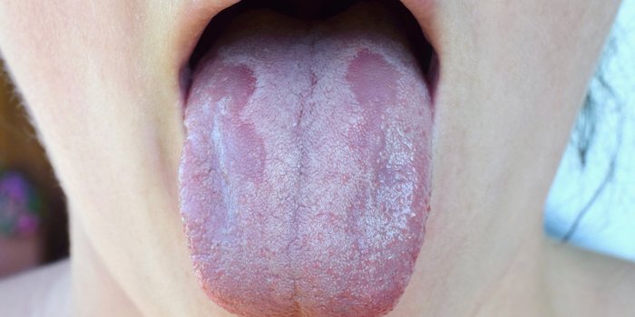 oral candidiasis or oral trush ( candida albicans), yeast infection on the human tongue close up, common side effect when...