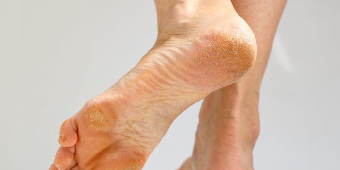 dry skin, plantar callosity and flakes on the female heel and feet sole close up on white background image for medical pu...
