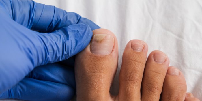 a doctor examines bare foot with onycholysis on a toenail after damaging with tight shoes or using gel-lacquer