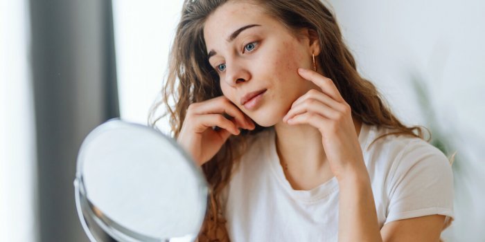young woman with problem skin looking into mirror