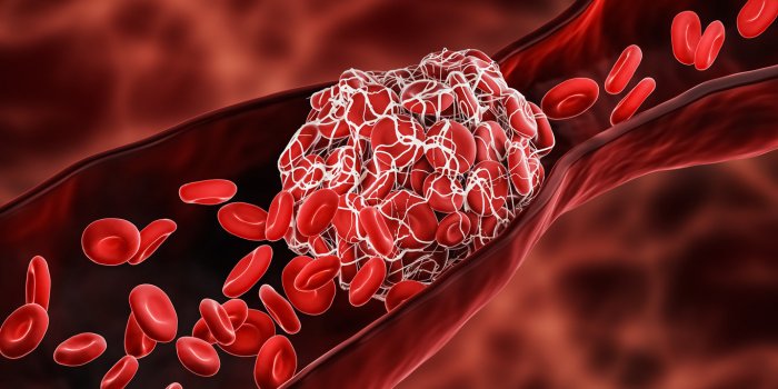 blood clot or thrombus blocking the red blood cells stream within an artery or a vein 3d rendering illustration thrombosi...