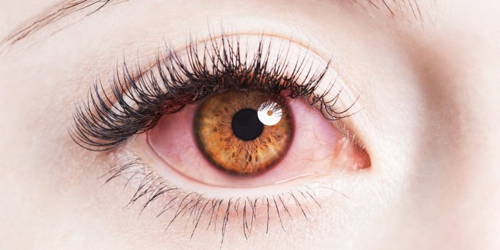 11 maladies qui donnent les yeux rouges
