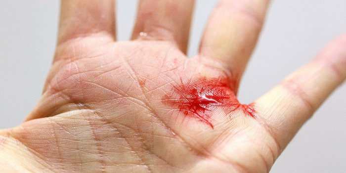 Randonnée : 7 astuces pour soigner les blessures les plus fréquentes