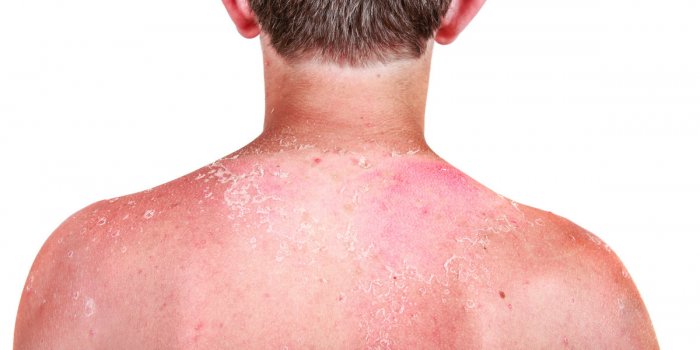 Coup de soleil : 8 conseils dâune dermatologue pour les apaiser et dÃ©rougir