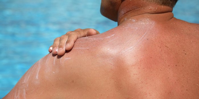 Coup de soleil : 8 conseils d’une dermatologue pour les apaiser et dérougir