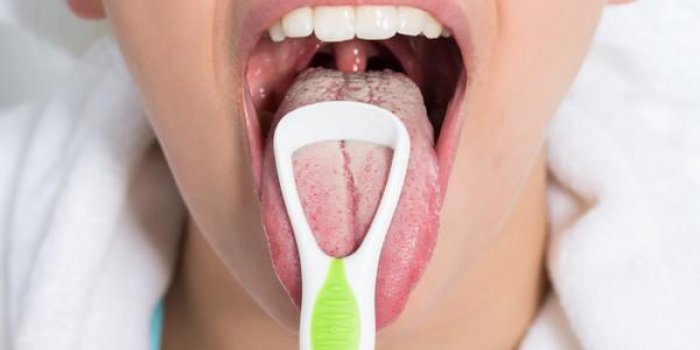 Un dépôt blanchâtre ou jaunâtre sur la langue