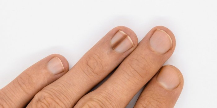 Cancer : plusieurs signes peuvent apparaitre sur vos ongles
