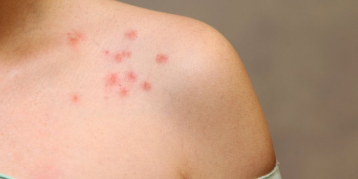 Vaccin contre la Covid-19 : 7 effets sur la peau Ã  surveiller