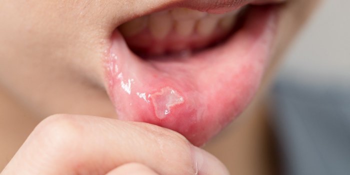 Cancer de la bouche : les 5 signes avant-coureurs Ã  observer au quotidien