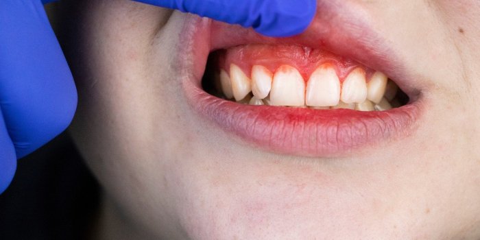 Cancer de la bouche : les 5 signes avant-coureurs Ã  observer au quotidien