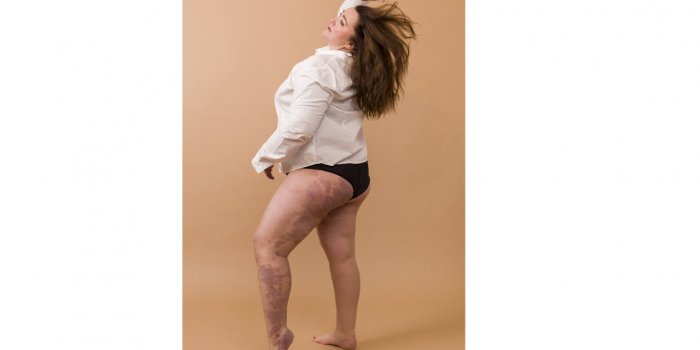 Cicatrices, poils... 16 femmes dÃ©voilent leurs jambes sans complexe