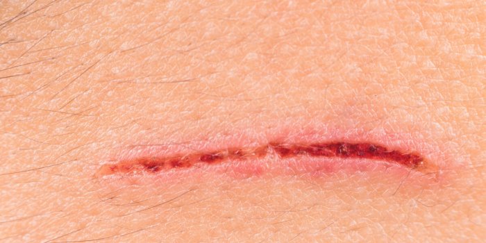 Cancer de la peau : 7 signes dans votre cuir chevelu qui doivent vous alerter