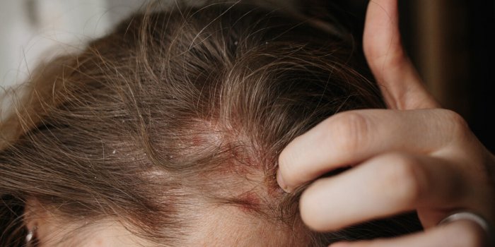 Cancer de la peau : 7 signes dans votre cuir chevelu qui doivent vous alerter