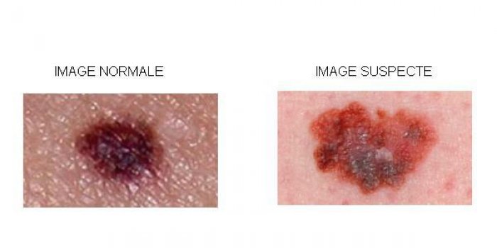 Cancer de la peau : 4 photos qui doivent alerter