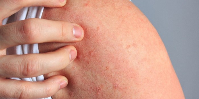Frelon asiatique : 7 symptômes qui doivent alerter après une piqûre