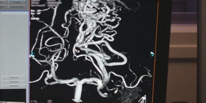 Comment réparer une malformation artério-veineuse dans le cerveau : les images au bloc