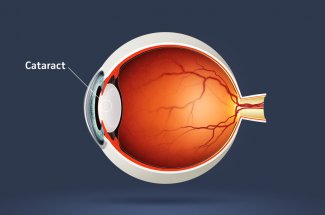 Cataracte : definition, symptomes, operation et traitements 