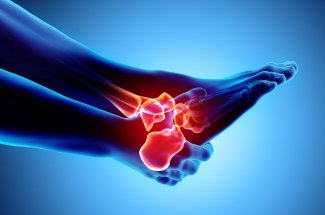 Aponevrosite plantaire (fasciite plantaire) : quels traitements pour soulager la douleur au pied ?