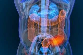 Cancer du colon (colorectal) : symptomes, esperance de vie, causes, traitements