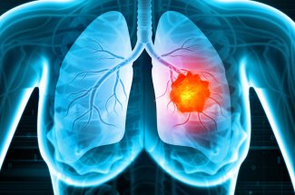Cancer du poumon : bientot un test urinaire pour le detecter ?