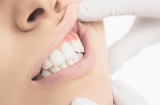 Leucoplasie de la langue, bouche, des gencives : symptomes et traitements