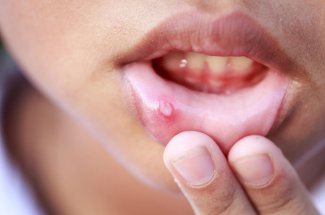 Aphte langue, bouche, gencive, levre… : symptomes, causes et traitements
