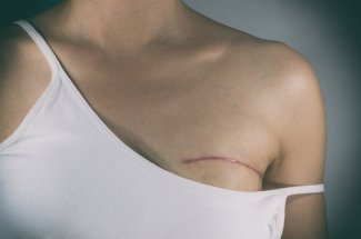 Cancer du sein : les signes qui annoncent une recidive