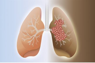 Cancer du poumon : symptomes, traitements, chance de survie, prevention 