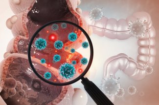 Cancer colorectal precoce : le microbiote intestinal en cause ?