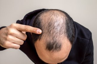 Alopecie : Edouard Philippe se confie sur sa maladie