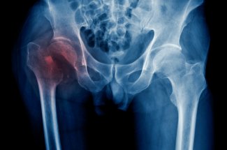 Fracture de la hanche : des habitudes simples peuvent reduire les risques