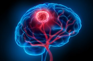 Tumeur cerebrale : 7 signes avant-coureurs que vous devez connaitre
