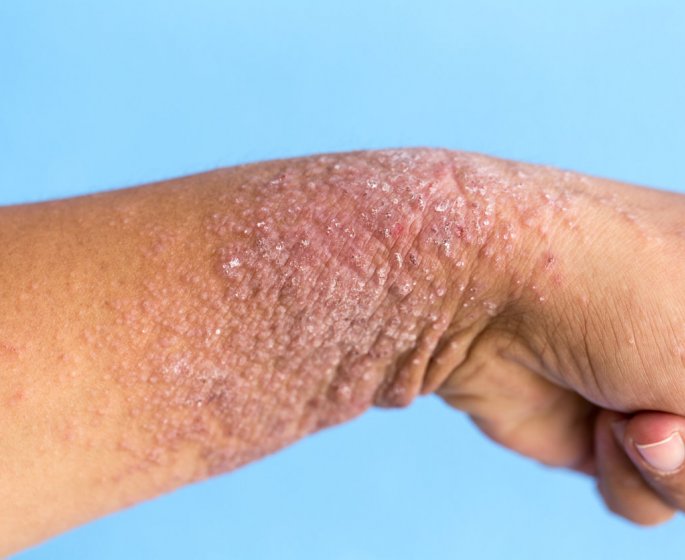 Dermatite atopique (Eczema atopique) : causes, symptomes, traitements 