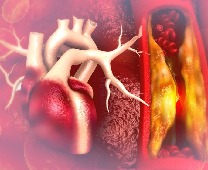 Arteriopathie obliterante (arterite) des membres inferieurs (AOMI) : causes et traitements