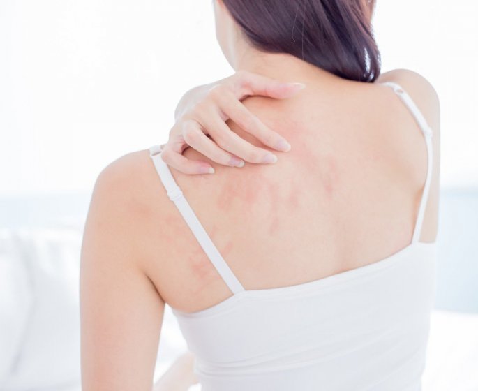 Eczema (ou dermatite allergique) de contact : symptomes et traitements pour le soigner