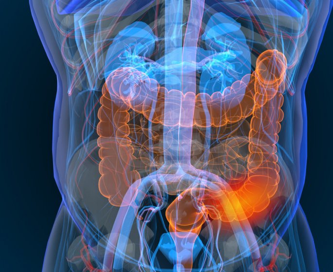 Cancer du colon (colorectal) : symptomes, esperance de vie, causes, traitements