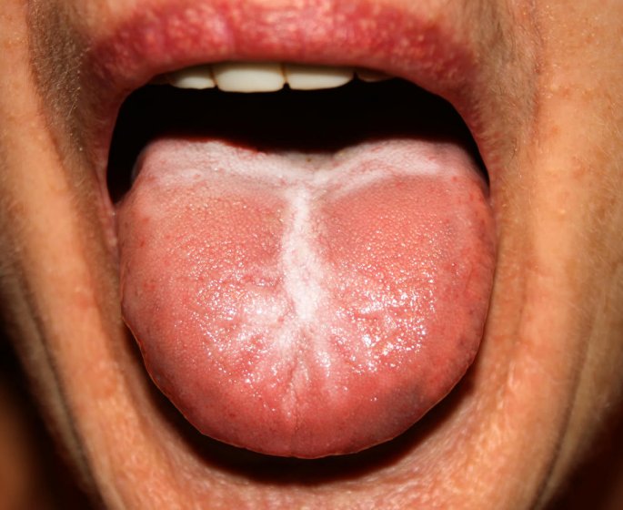 Mycose de la bouche : qu-est-ce que le muguet buccal ?