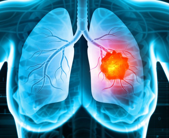 Cancer du poumon : bientot un test urinaire pour le detecter ?