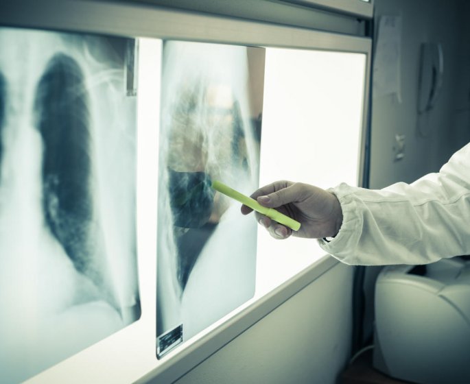 Metastase pulmonaire : le cancer secondaire du poumon