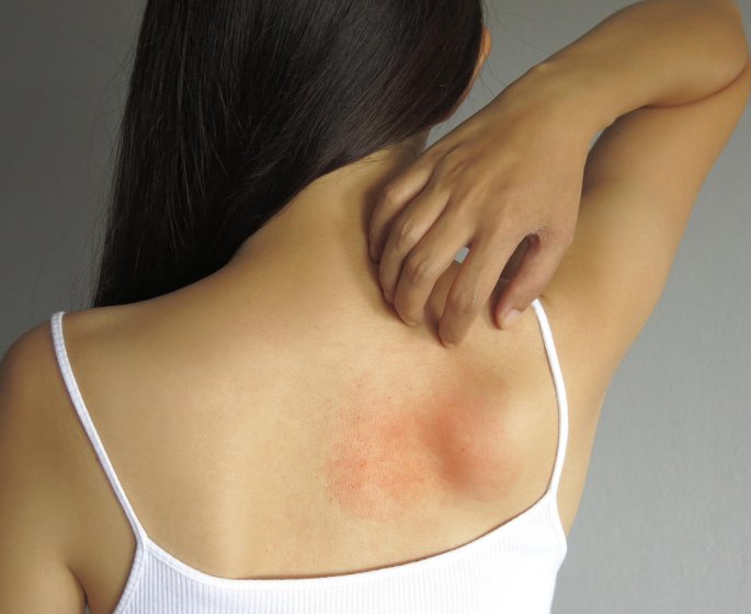Allergie cutanee : a quoi ressemble une urticaire ?