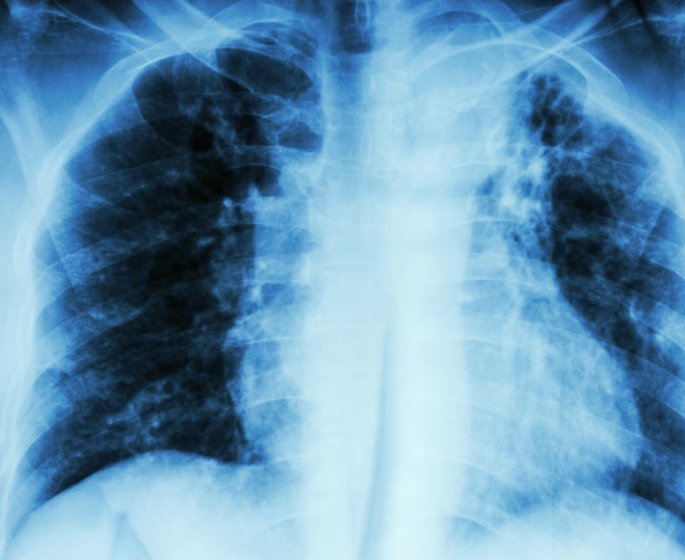 Tuberculose (pulmonaire, osseuse…) : symptomes, test, vaccin et traitements