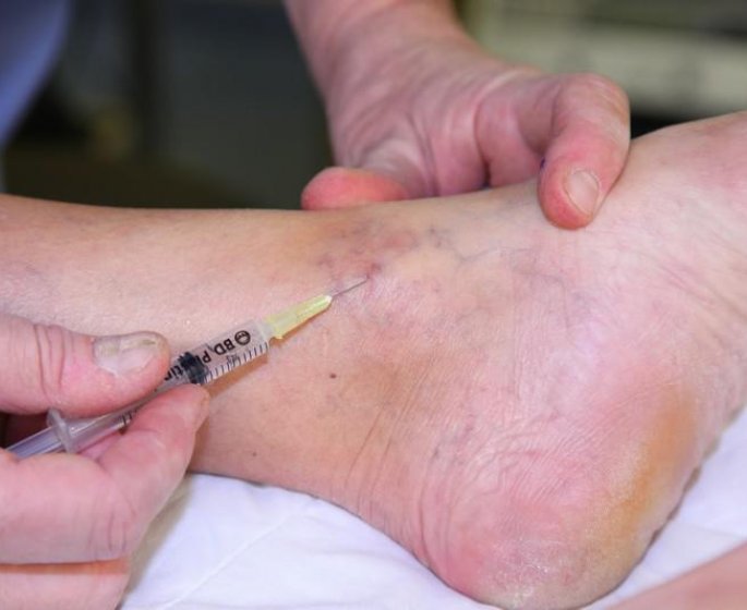 L-anesthesie locoregionale pour le pied