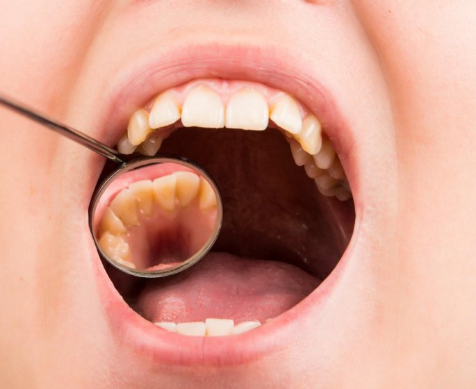 Glossodynie (douleurs a la langue) : quels traitements pour la soigner ?