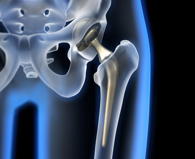 Coxarthrose, arthrose de la hanche : quels symptomes et traitements pour la soigner ?