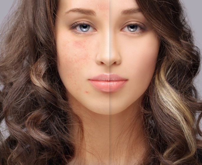 Top 3 des serums qui feront disparaitre votre acne